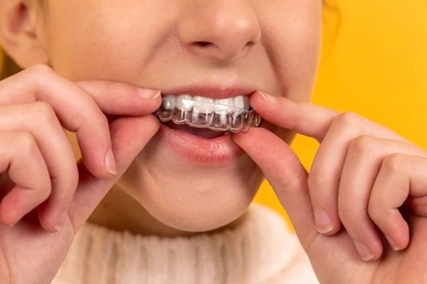 Comparación de tono dental en un blanqueamiento
